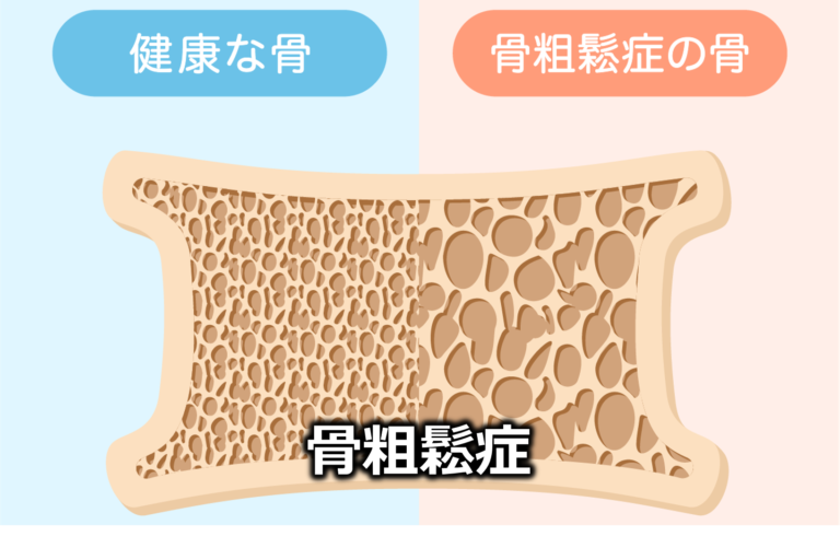 骨粗鬆症の骨