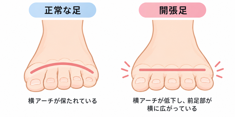 開張足