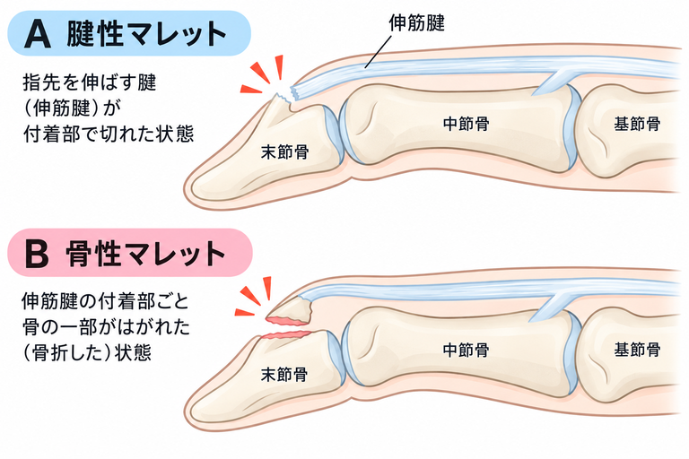 マレットフィンガー（槌指）